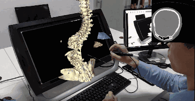 “mVR虚拟现实手术规划系统处理脊柱的临床案例”